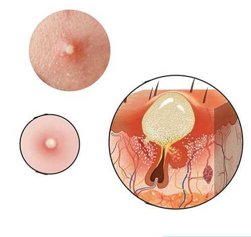 Nổi mụn đầu trắng ở vùng kín nữ giới là bệnh gì? Cách chữa trị