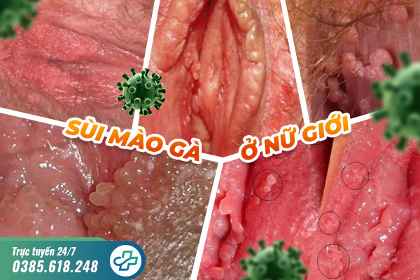 Sùi mào gà ở nữ giới nguy hiểm như thế nào? Cách điều trị hiệu quả