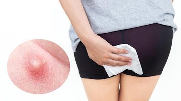 Mụn thịt hậu môn: Cảnh báo nguy hiểm từ dấu hiệu nhỏ nhặt đến mầm mống ung thư