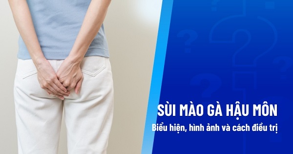 Sùi mào gà hậu môn – 10+ Thông tin quan trọng bạn cần nắm rõ